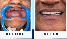 Before and after dental treatment comparison.