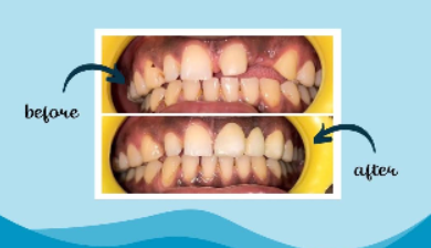 Before and after dental treatment comparison with clinical photographs.